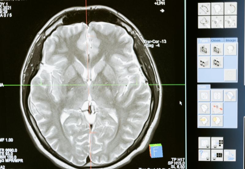Causes Of TBI & Brain Injury In Legal Claims