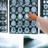 Understanding Brain Injury & What Clients Should Know About Traumatic Brain Injury Symptoms (TBI)
