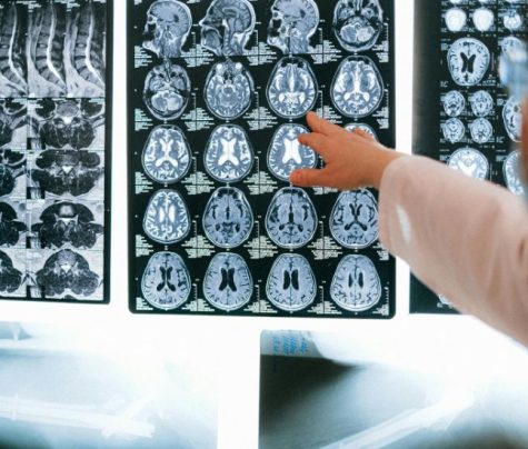 traumatic brain injury lawyers