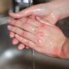What Types of Burn Injuries Warrant a Personal Injury Lawsuit?